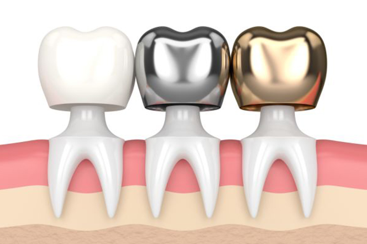 https://dentistgurugram.com/wp-content/uploads/2021/10/CROWNS1.jpg