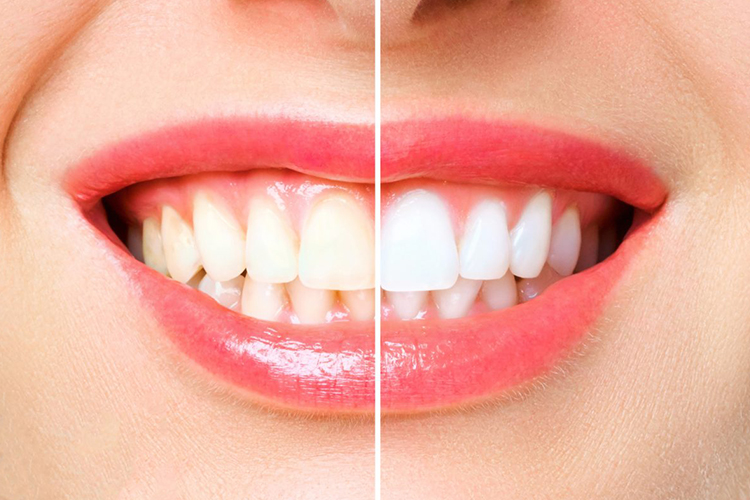 https://dentistgurugram.com/wp-content/uploads/2021/10/TEETH-WHITENING1.jpg