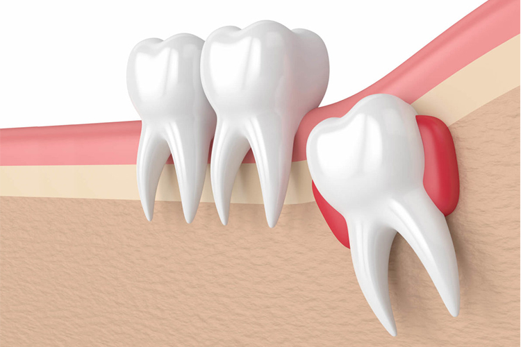 https://dentistgurugram.com/wp-content/uploads/2021/10/WISDOM-TOOTH-EXTRACTION.jpg