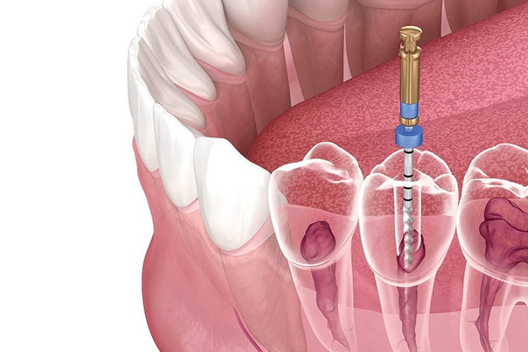 https://dentistgurugram.com/wp-content/uploads/2021/11/ROOT-CANAL-TREATMENT-1.jpg